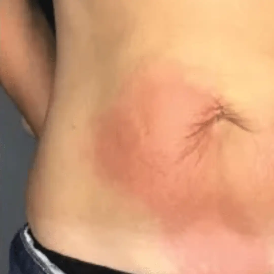 Firm skin in abdomen after Cryo T-Shock treatment.