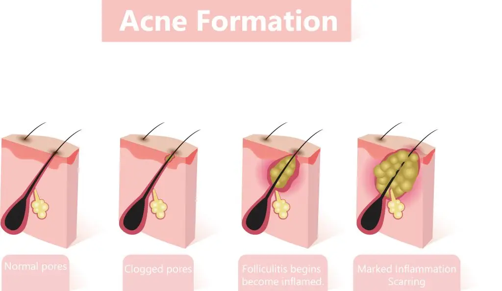 Skin Follicle showing how we get acne