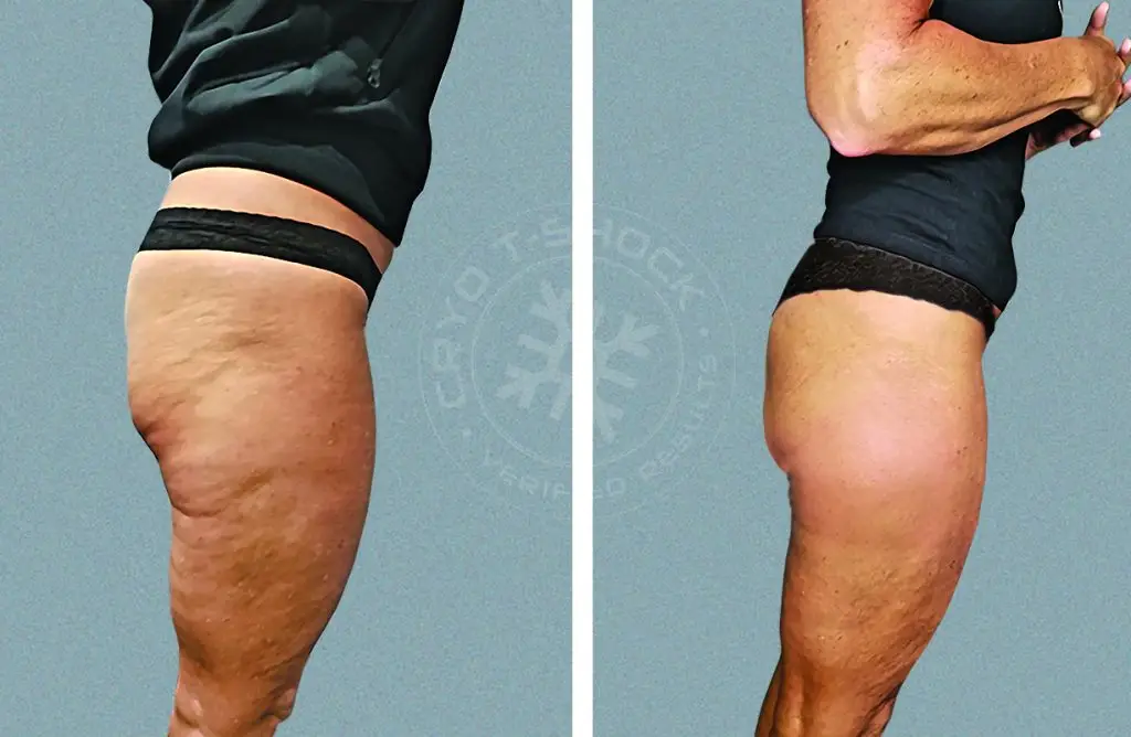 Cryo T-Shock before and after picture, showing the smoothing out of cellulite on the thighs after treatment.