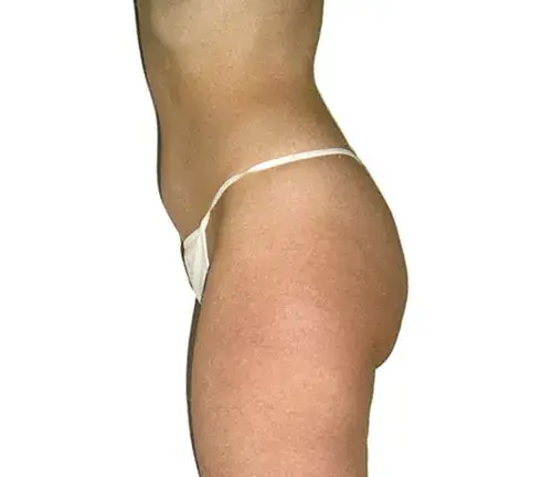 Sideview of a woman's stomach and glutes showing fat loss results from a body sculpting massage.