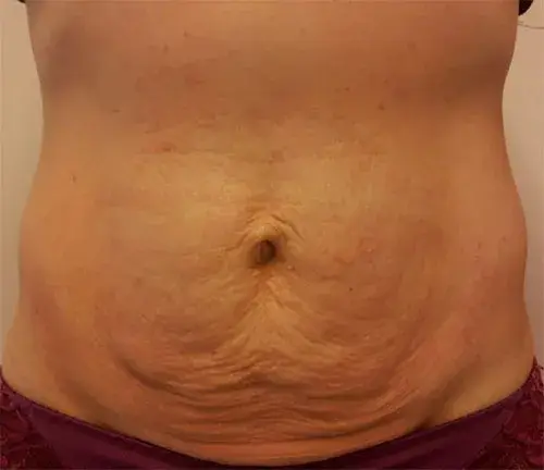 Loose skin on abdomen before LPG Endermologie treatment.