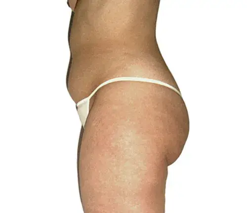 Sideview of a woman's stomach and glutes before a body sculpting massage.