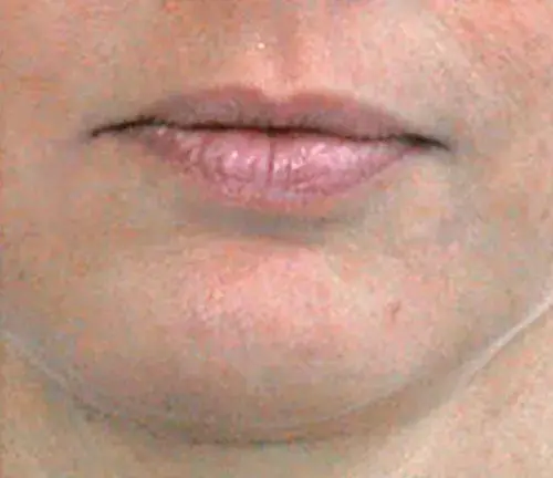 Woman's mouth seen without frown lines after face sculpting treatment.